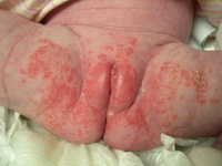 diaper candida_resize